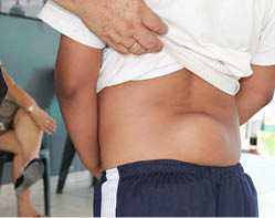 menor con tumor en espalda