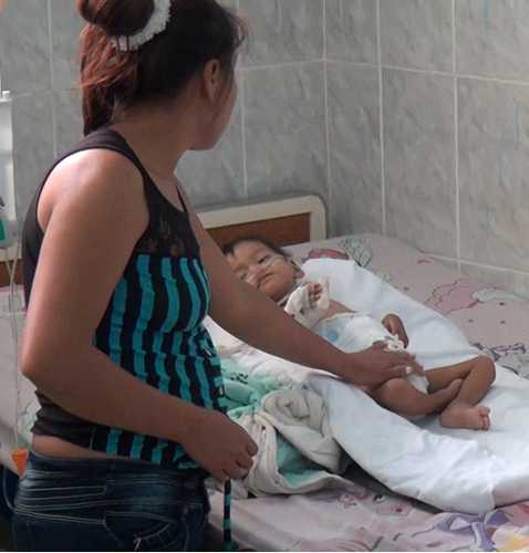 NIÑO CON DESNUTRICIÓN