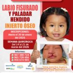 Hospital II-2 Tarapoto abre inscripciones para la XIV Campaña Gratuira de Labio y Paladar Hendido e Injerto Óseo