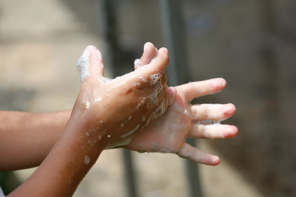 San Martín supera los 500 casos de virus coxsackie y autoridades refuerzan alerta sanitaria en colegios