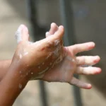 San Martín supera los 500 casos de virus coxsackie y autoridades refuerzan alerta sanitaria en colegios